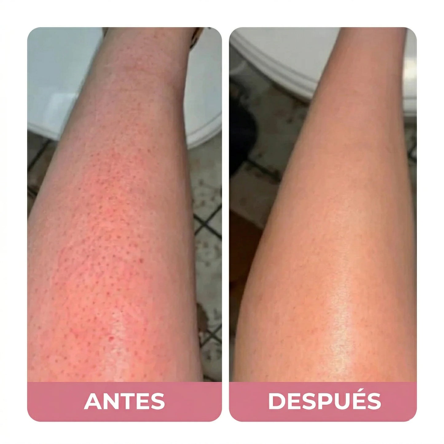 Razerly™️ | Depilación sin irritación ni vellos encarnados.