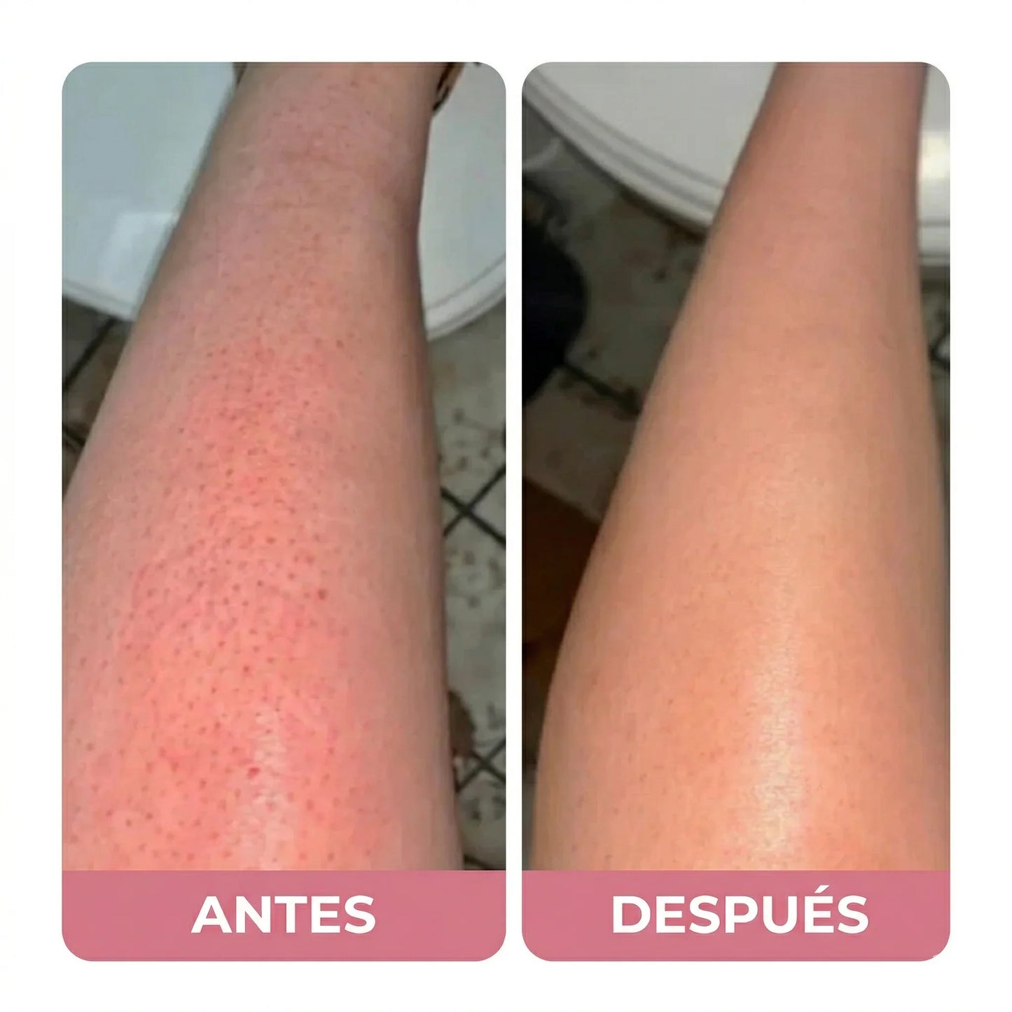 Razerly™️ | Depilación sin irritación ni vellos encarnados.