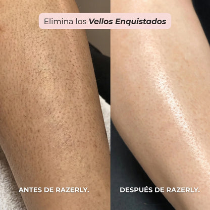 Razerly™️ | Depilación sin irritación ni vellos encarnados.