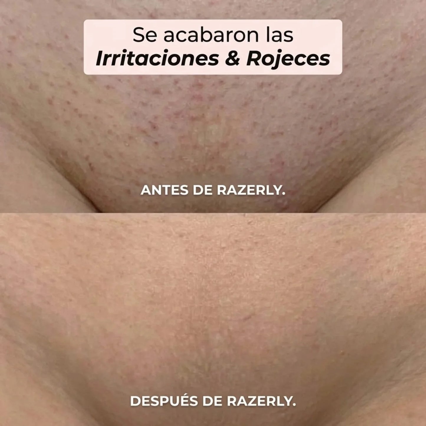 Razerly™️ | Depilación sin irritación ni vellos encarnados.