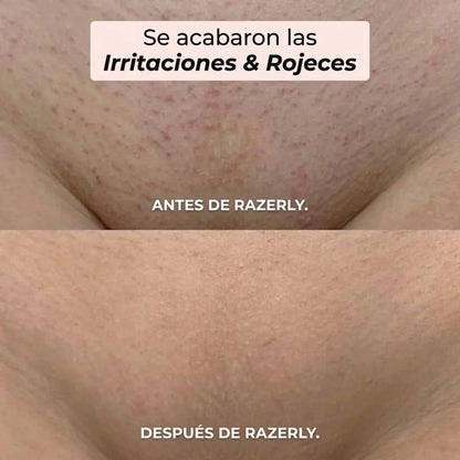 Razerly™️ | Depilación sin irritación ni vellos encarnados.