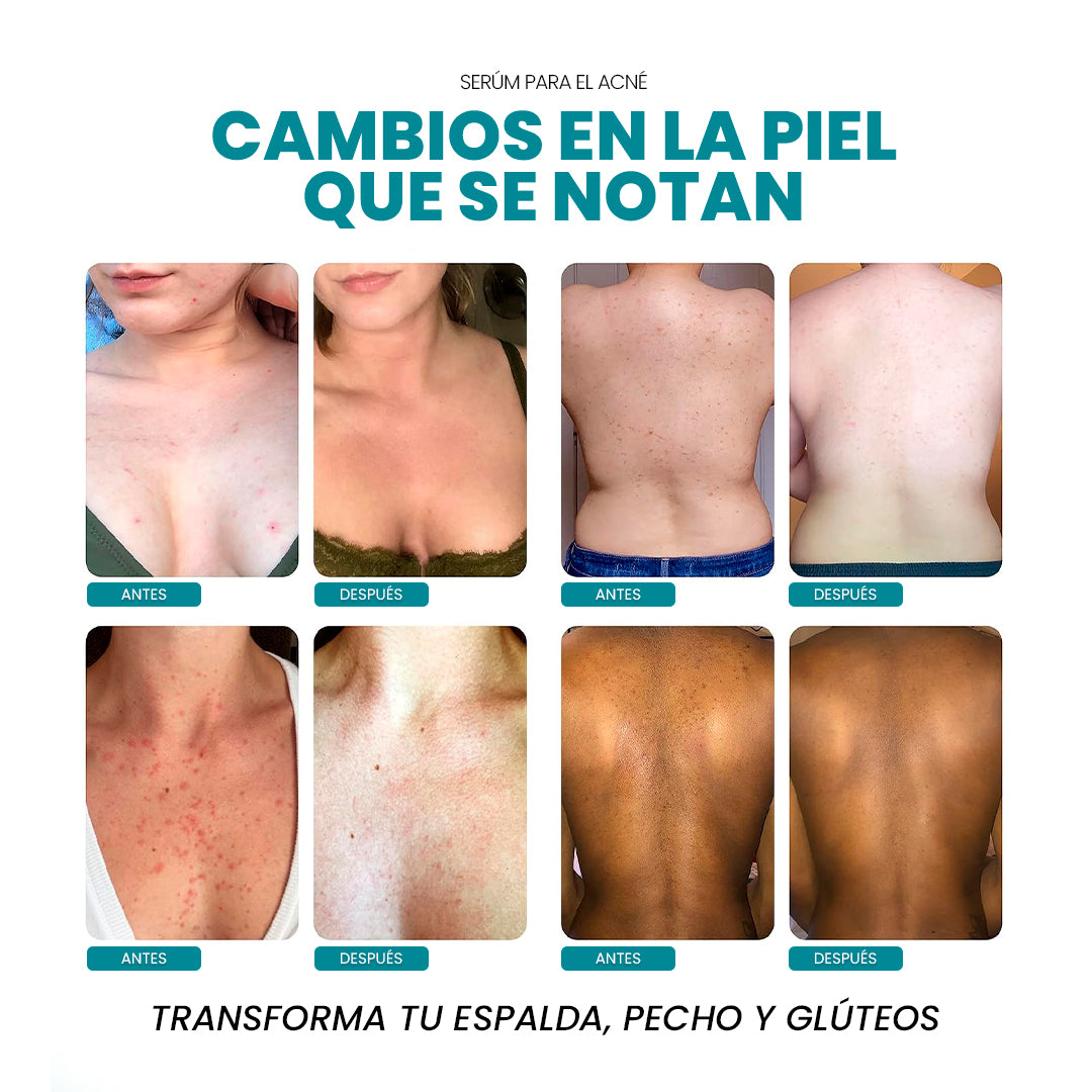 Elimina el Acné Corporal y la Foliculitis desde la Raíz